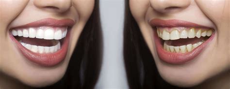 Unveiling the Secrets of Magic White Teeth Whitening